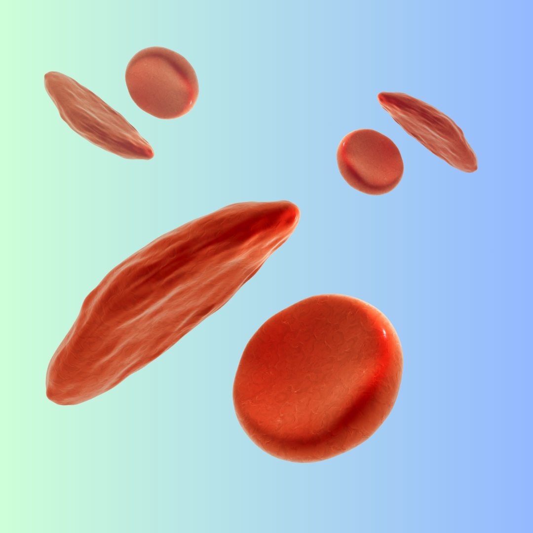 sickle cell