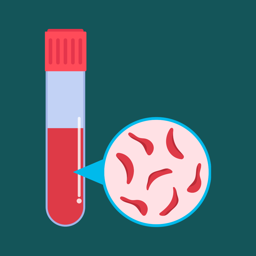 Image is a graphic of a vial with a red cap filled with blood, and a circle containing a zoom-in view of the blood inside the vial, which shows crescent-shaped blood cells indicative of sickle cell disease.