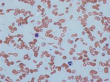 sickle cells