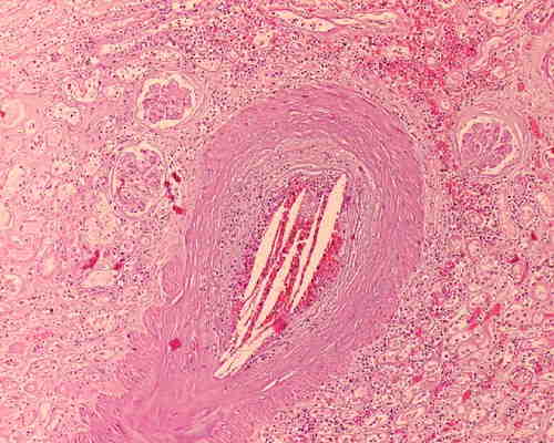 Cholesterol emboli