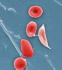 sickle cells