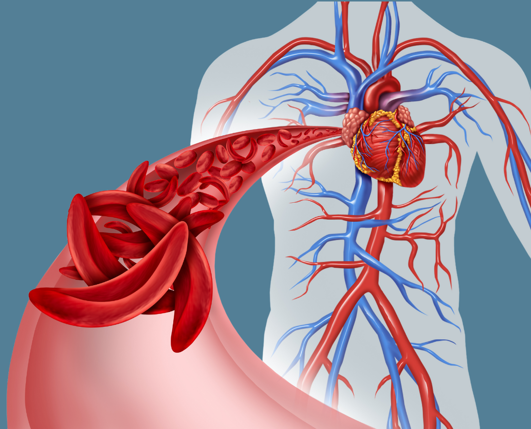 anatomical human body with closeup of sickle cells