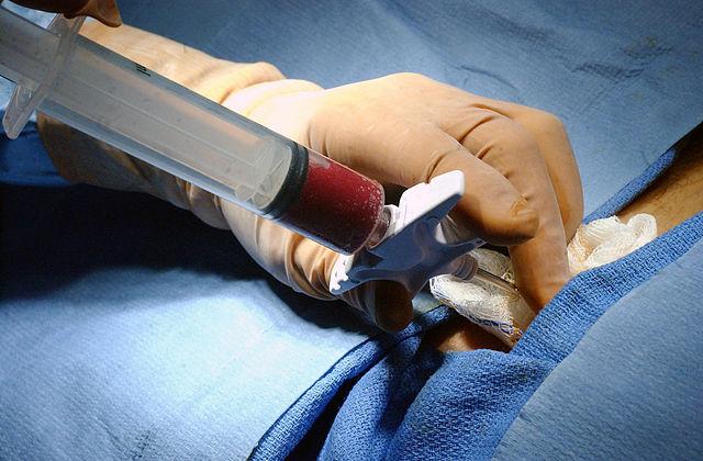 A gloved hand holds a large syringe that is partially filled with bone marrow