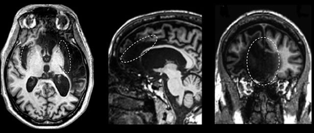 Patient's brain scan